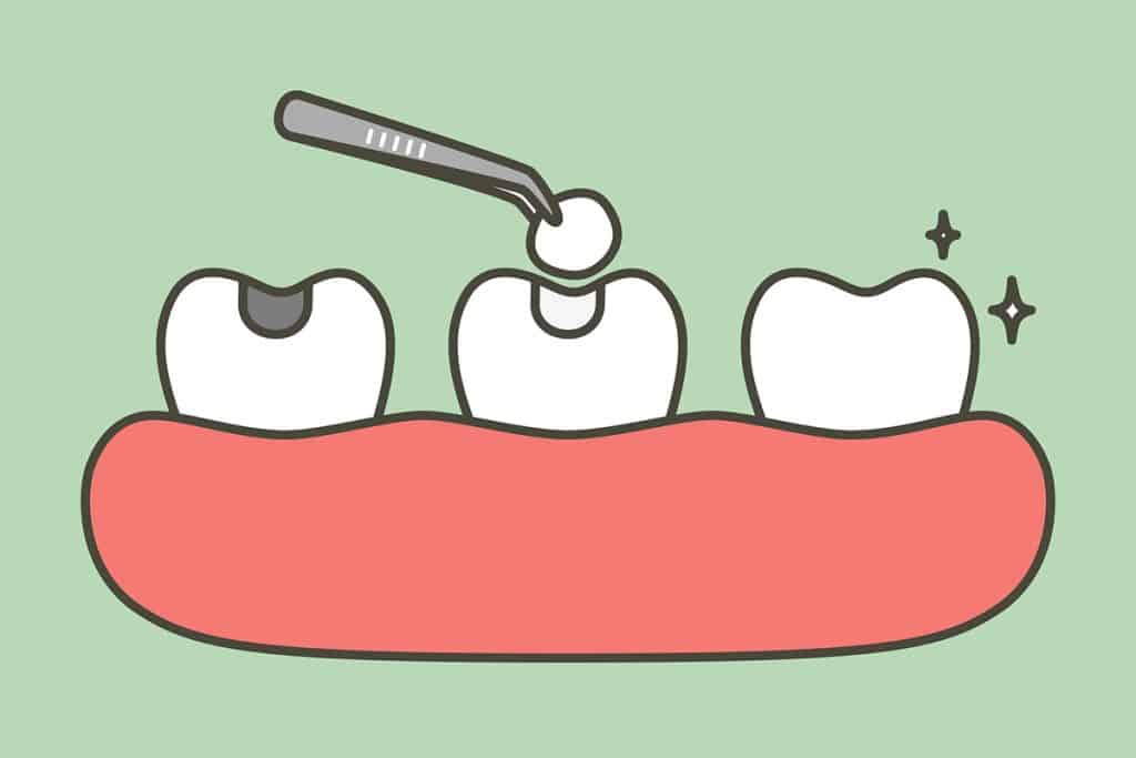 Beyond the Fillings: Safe Amalgam Removal & Whole-Body