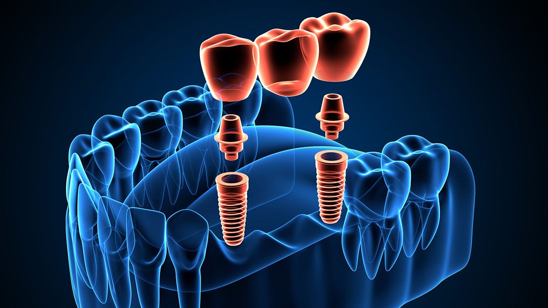 Dental Bridges